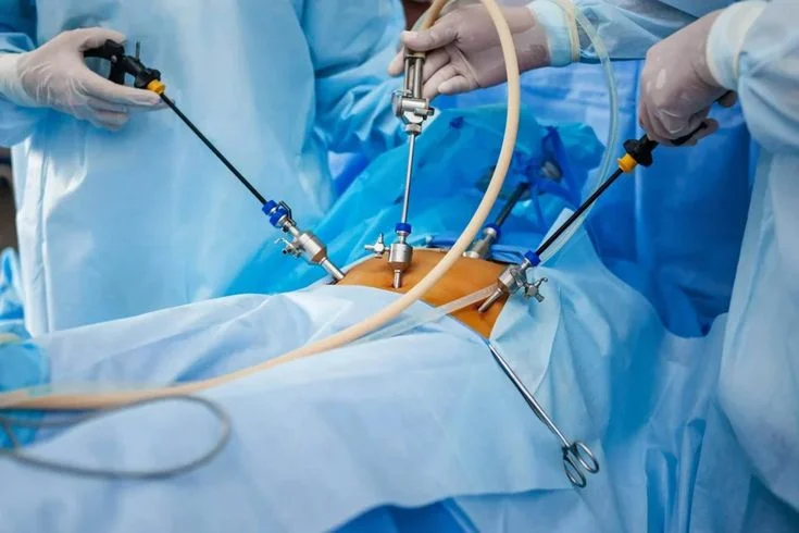 Laparoscopic Fibroid Removal Tips by Dr. Samar Hussain